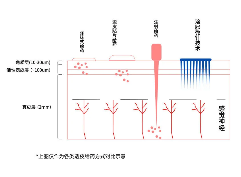 微针量产技术